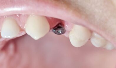 İmplant Diş Nedir ve Nasıl Yapılır?