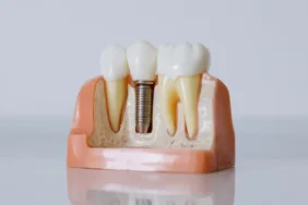 implant